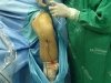 Cirurgia de LCA