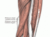Epicondilite lateral