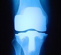 Protocolo avançado de cirurgia no joelho