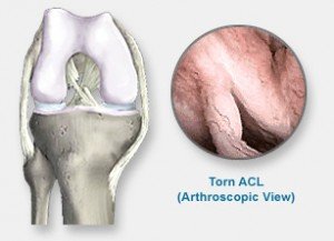Ligamento cruzado anterior roto. Figura 2. Ligamento cruzado anterior roto.