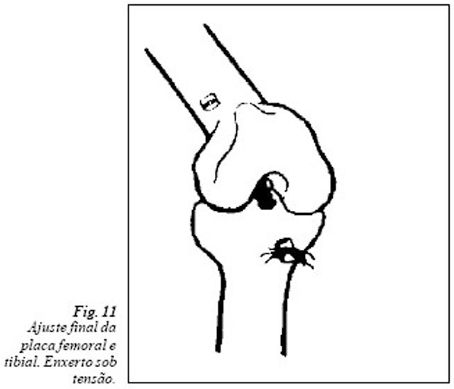 ajuste final da placa femoral e tibial (fig 11)