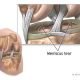 lesao-meniscal (1)