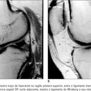 lesao-meniscal (3)