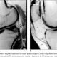 lesao-meniscal (3)