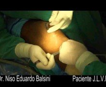 Ligamento patelo femoral