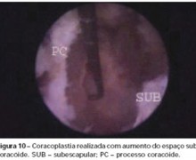 coracoplastia (fig 01)