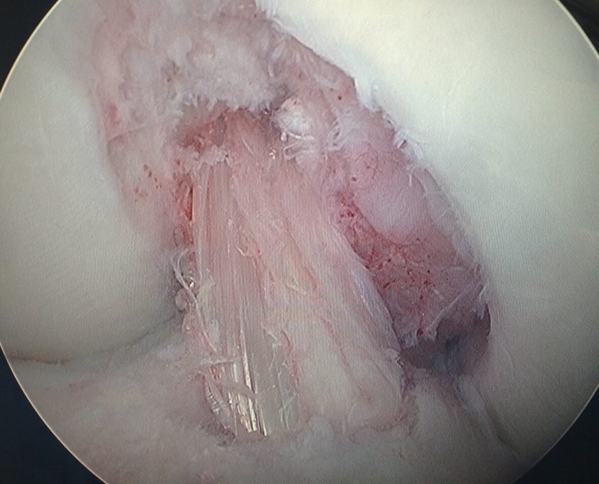 Figura 10 - Imagem de um ligamento cruzado anterior reconstruido com enxerto dos tendoes flexores - semitendineo e gracilis