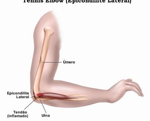 epicondilite-lateral (1)