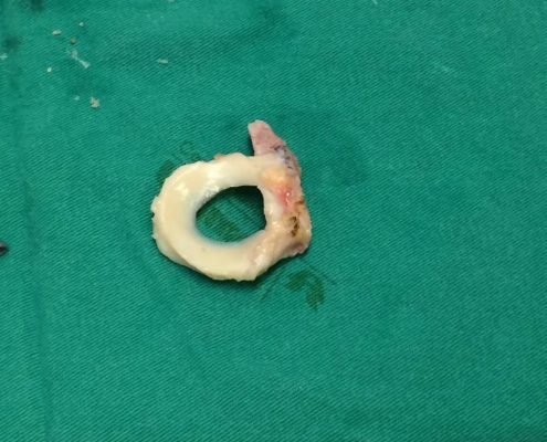 Primeira cirurgia de transplante meniscal de Santa Catarina (1)
