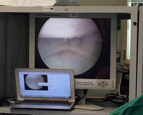 Primeira cirurgia de transplante meniscal de Santa Catarina