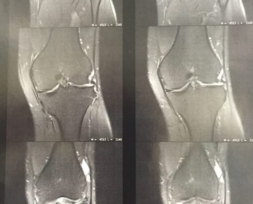 Primeira cirurgia de transplante meniscal de Santa Catarina